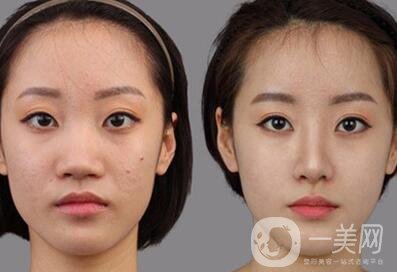 鼻翼縮小術(shù)