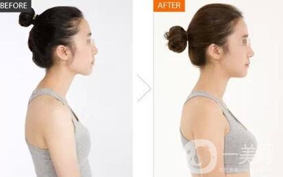 隆胸假體取出有沒有后遺癥？要怎么護(hù)理？