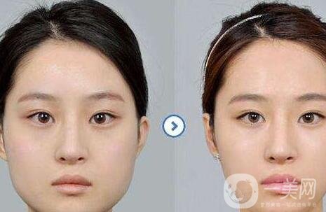 哪家醫(yī)院做削骨手術(shù)比較*？正規(guī)醫(yī)院怎么選？