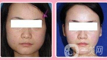 哪家醫(yī)院做削骨手術(shù)比較*？正規(guī)醫(yī)院怎么選？