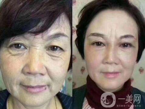 激光除皺會傷害皮膚嗎?副作用有哪些?