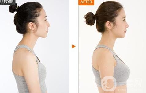 假體隆胸有哪些優(yōu)勢和缺點?為小白詳細解說