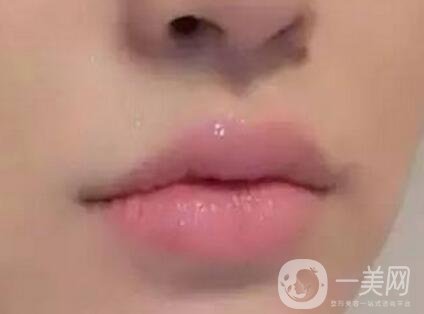 玻尿酸豐唇術(shù) 