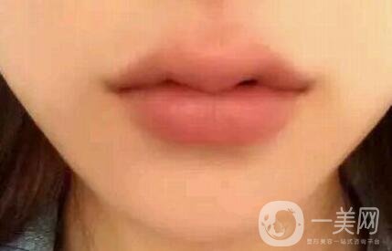 玻尿酸豐唇術(shù) 