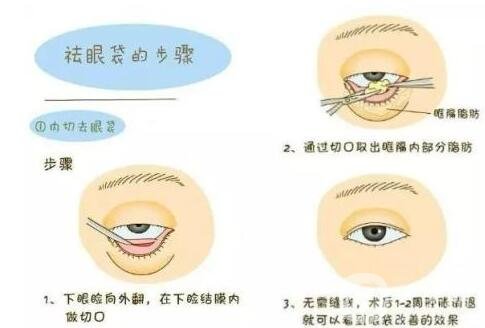 解答：不手術(shù)去眼袋的方法有沒(méi)有?是商家噱頭嗎?