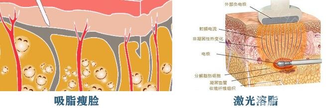 激光溶脂瘦臉后要注意什么啊?