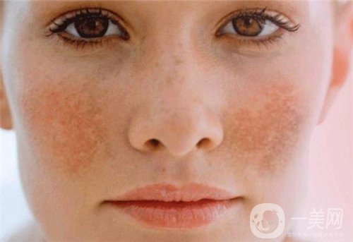 激光去雀斑會(huì)反彈嗎?術(shù)后注意事項(xiàng)有哪些?