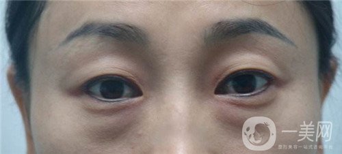 激光去眼袋的價格多少？要打幾次？