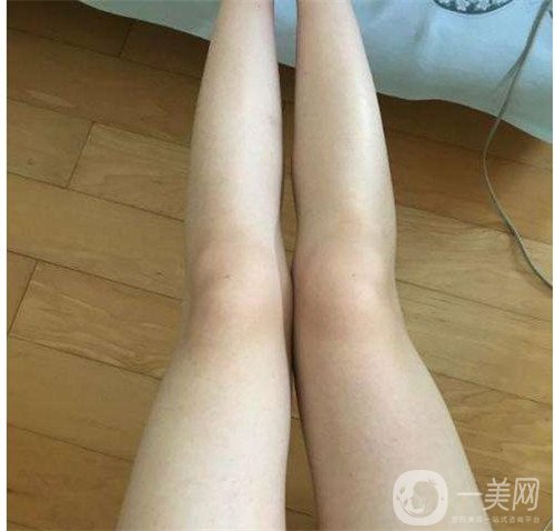 激光溶脂瘦大腿疼嗎？可以忍受嗎？