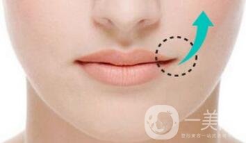嘴角上揚(yáng)整形