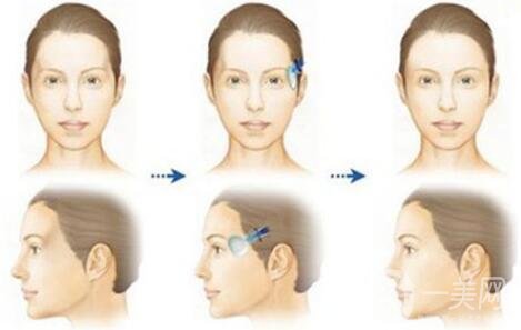 自體脂肪豐太陽(yáng)穴