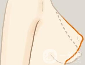 乳房下垂矯正后會反彈再次下垂嗎？術(shù)后穿什么內(nèi)衣？