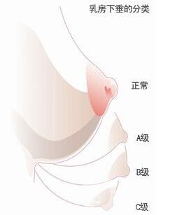 乳房下垂矯正后會反彈再次下垂嗎？術(shù)后穿什么內(nèi)衣？