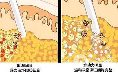 水動(dòng)力吸脂減肥后為什么不會(huì)反彈?好處在哪兒?