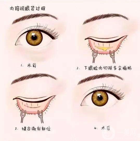 去眼袋,手術(shù),價格,是多少,與哪些因素有關,