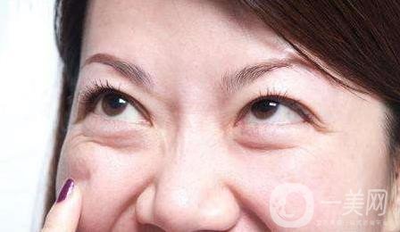 去眼袋,手術(shù),價格,是多少,與哪些因素有關,