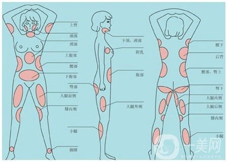 全身吸脂減肥危害大嗎？會不會死人？