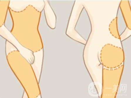 全身吸脂減肥危害大嗎？會不會死人？