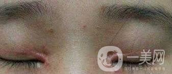 開眼角疤痕增生