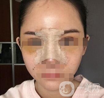 隆鼻固定膠帶幾天去掉？術(shù)后6天去掉會(huì)不會(huì)太早？