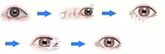 開(kāi)眼角失敗怎么辦?還可以再修復(fù)嗎?