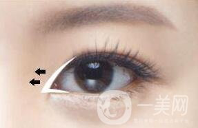 開(kāi)眼角失敗怎么辦?還可以再修復(fù)嗎?