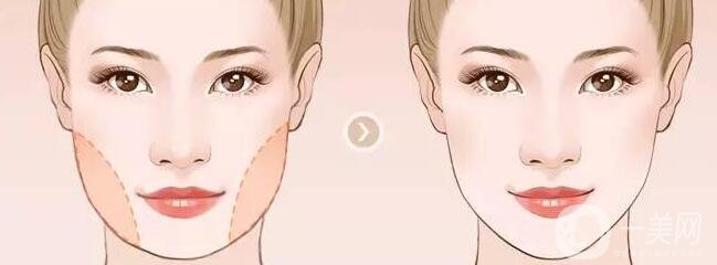 寬下頜角整形手術(shù)原來(lái)是這樣做的!【解析】