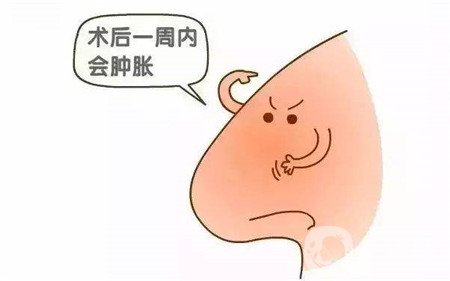 隆鼻手術(shù)恢復要多久才能自然？這期間要注意什么？