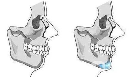 隆下巴假體硅膠好還是膨體好？