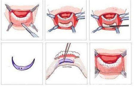 隆下巴假體歪了可以修復嗎？