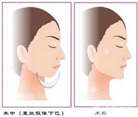 隆下巴假體歪了可以修復嗎？