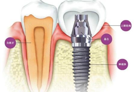 湖州種植牙多少錢 