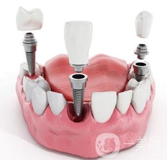 湖州種植牙多少錢 