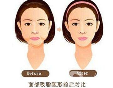 面部抽脂之后皮膚會(huì)變得松弛嗎？