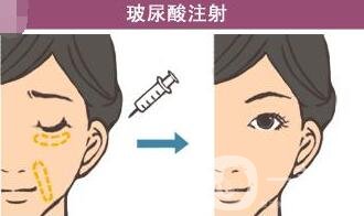 注射玻尿酸危害大嗎?有沒有毀容的風險?