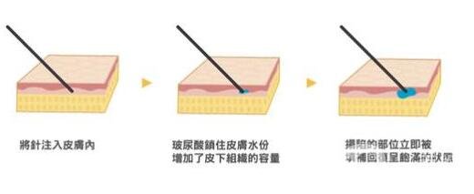 注射透明質(zhì)酸疼嗎?需要注意什么?