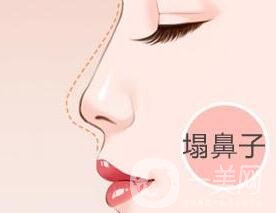 自體軟骨隆鼻費(fèi)用貴嗎?要多少錢?