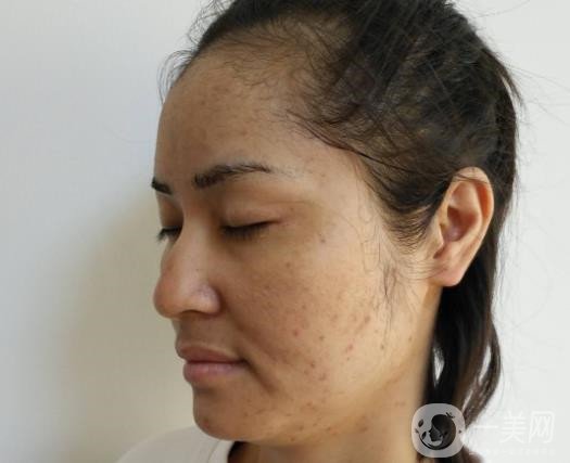 激光祛斑祛痘的后遺癥，你知道嗎？