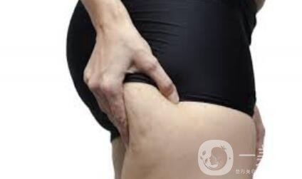 臀部吸脂手術(shù)