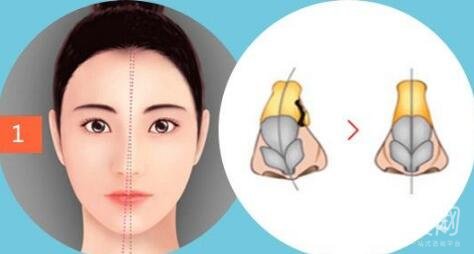 歪鼻矯正注意事項(xiàng)