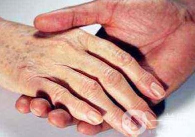 怎樣去掉手上的老年斑？還會再生嗎？