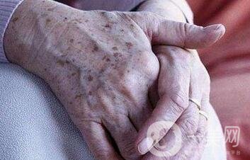 怎樣去掉手上的老年斑？還會再生嗎？