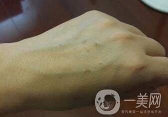 怎樣去掉手上的老年斑？還會再生嗎？