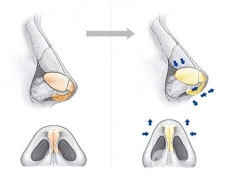 哪些人不適合硅膠隆鼻？禁忌人群是哪些？