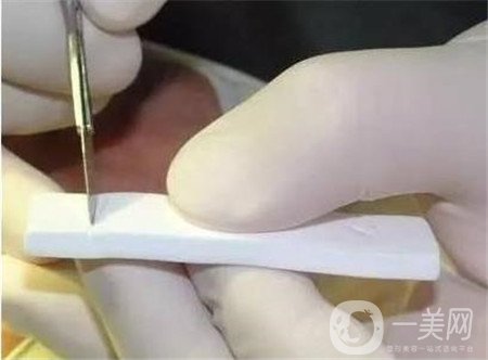 膨體隆鼻術(shù)后注意事項有哪些？需要忌口嗎？