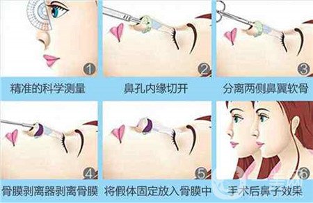 膨體隆鼻術(shù)后注意事項有哪些？需要忌口嗎？