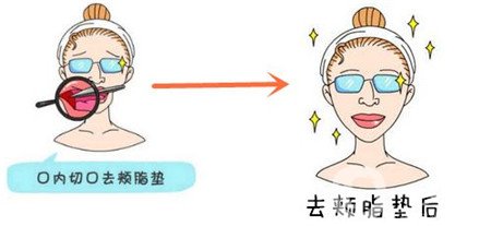 去頰脂墊幾天消腫?多久才能正常吃飯?