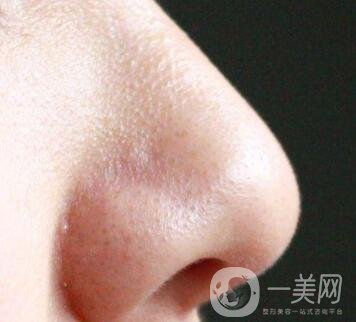 鼻子長(zhǎng)黑頭怎么辦？做激光有用嗎？