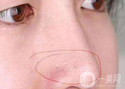 鼻子長(zhǎng)黑頭怎么辦？做激光有用嗎？