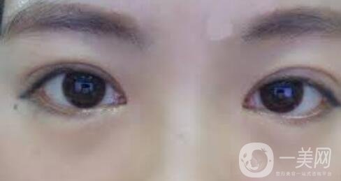 韓式微創(chuàng)雙眼皮手術(shù)